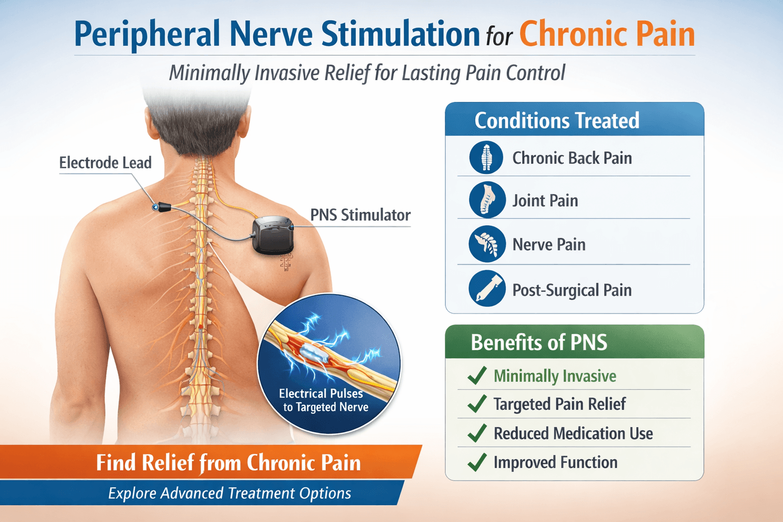 Diagram showing peripheral nerve stimulation for chronic pain, with an electrode lead and PNS stimulator on a person’s back. Lists treated conditions, benefits of PNS, and highlights minimally invasive pain relief.