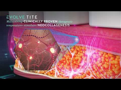 Cross-section illustration of skin layers showing a cosmetic treatment device emitting energy, with highlighted regions and text about maintaining therapeutic temperatures to stimulate neocollagenesis for Evolve Tite.